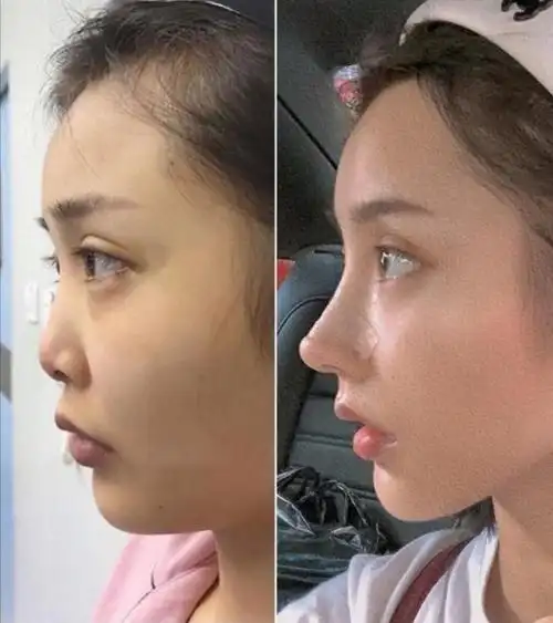 5w-4w不等,具体看初鼻基础来判定不同的调整项目线雕隆鼻简单来说