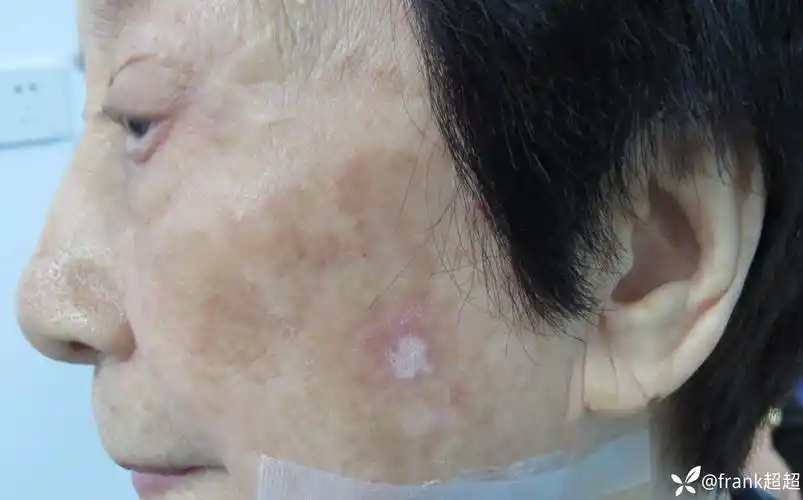 看图诊断老年女性左侧面部红斑鳞屑考虑是癌前病变