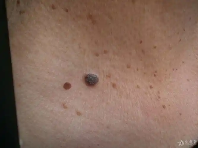 脂溢性角化(附病理图片).