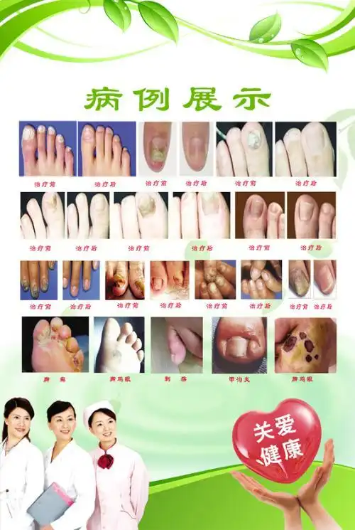 我得了灰指甲不知道怎么办,求有效的治疗方法!