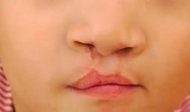 我的宝宝是兔唇裂我该带他来到这个世界上吗