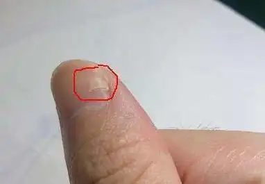 指甲出现这些斑点或是癌症前兆大意不得
