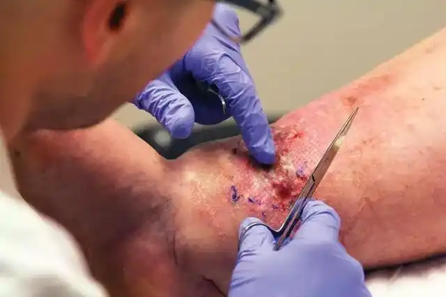 医用蛆虫疗法治疗溃烂伤口