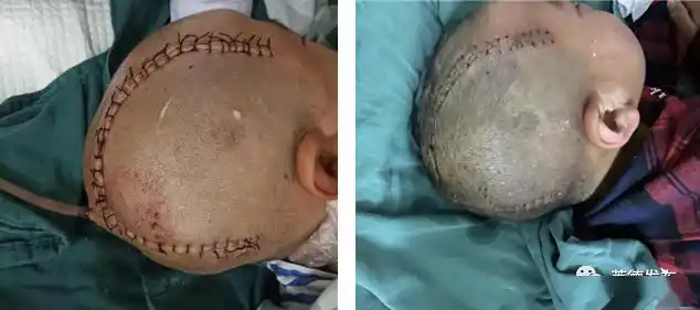 英德东华镇中心卫生院成功实施首例小儿开颅手术