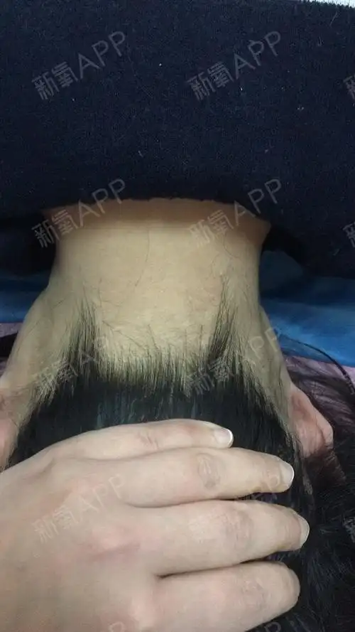 觉得后颈头发太长想脱一脱要做五到八次医生说可以包干_圈子-新氧美容