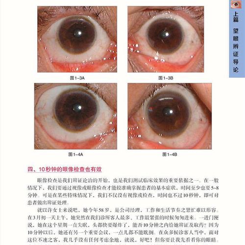 辨证中医诊断望目情况反应眼睛疾病各种诊病中医