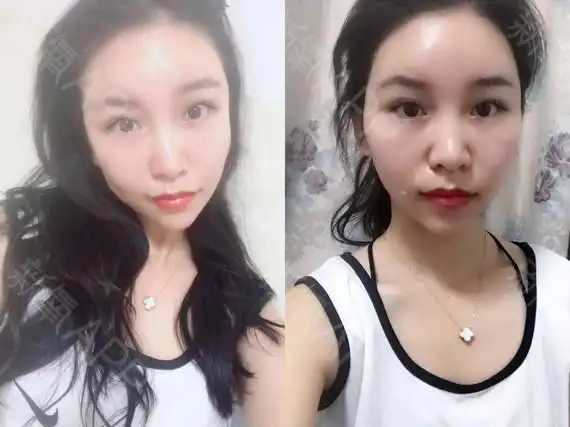 昨天医院的工作人员还打电话我的恢复情况,还叮嘱我脸部现在还没有