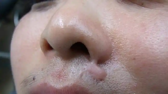 我是鼻子下面的增生性疤痕.
