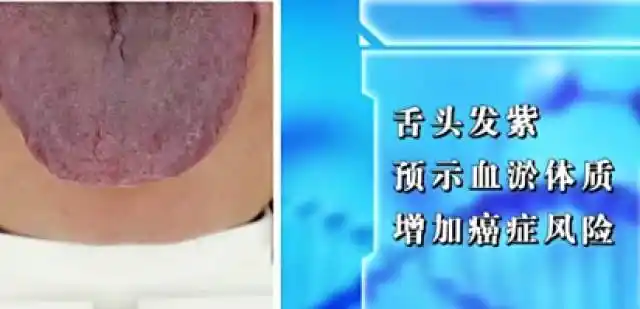肝癌,胃癌,宫颈癌舌头发紫,是血瘀体质的表现,如果出现了这种情况