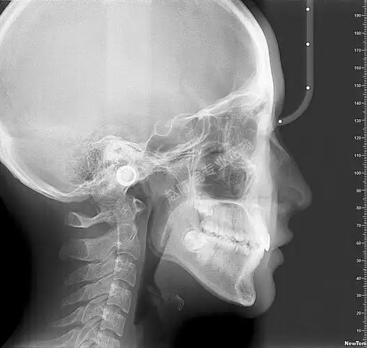 杭州看牙赵陈皖-青少年隐形牙齿矫正案例