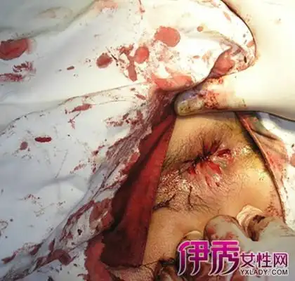 >> 文章内容 >> 外痔疮怎么治 外痔疮怎么能让肉