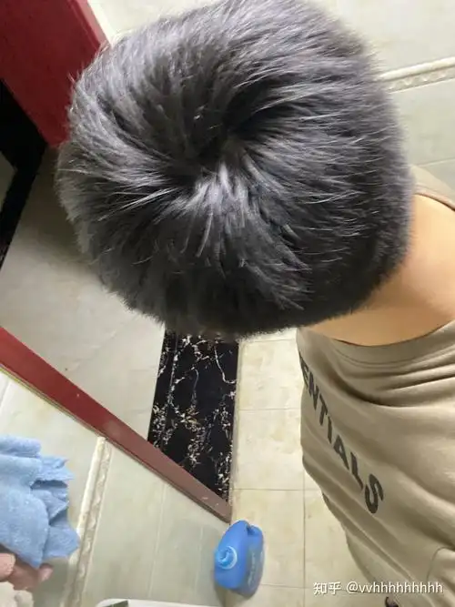 什么样子的发旋是正常的啊