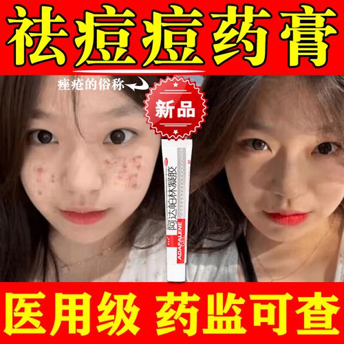 祛痘膏学生青春痘淡化祛痘印淡化痘印痘坑药膏 痤疮黑头粉刺外用药