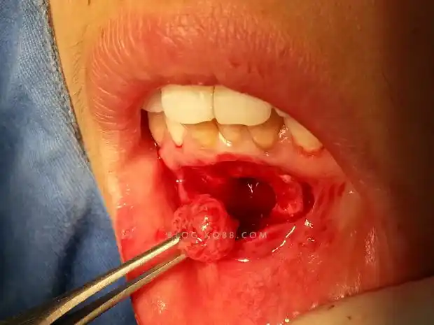 一例根尖区手术病例