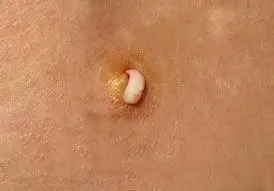 展开全部 这个是小粉瘤,没有什么害处,最好等它再大点就可以弄破它