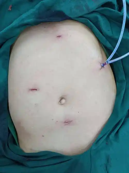 【病例夹】当脾破裂遇到腹腔镜微创手术_王先生_脾脏_损伤