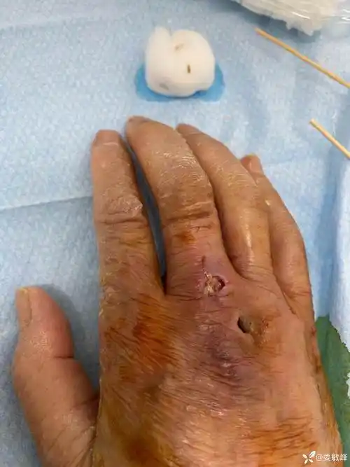 求助狗咬伤一月余后切口一直感染