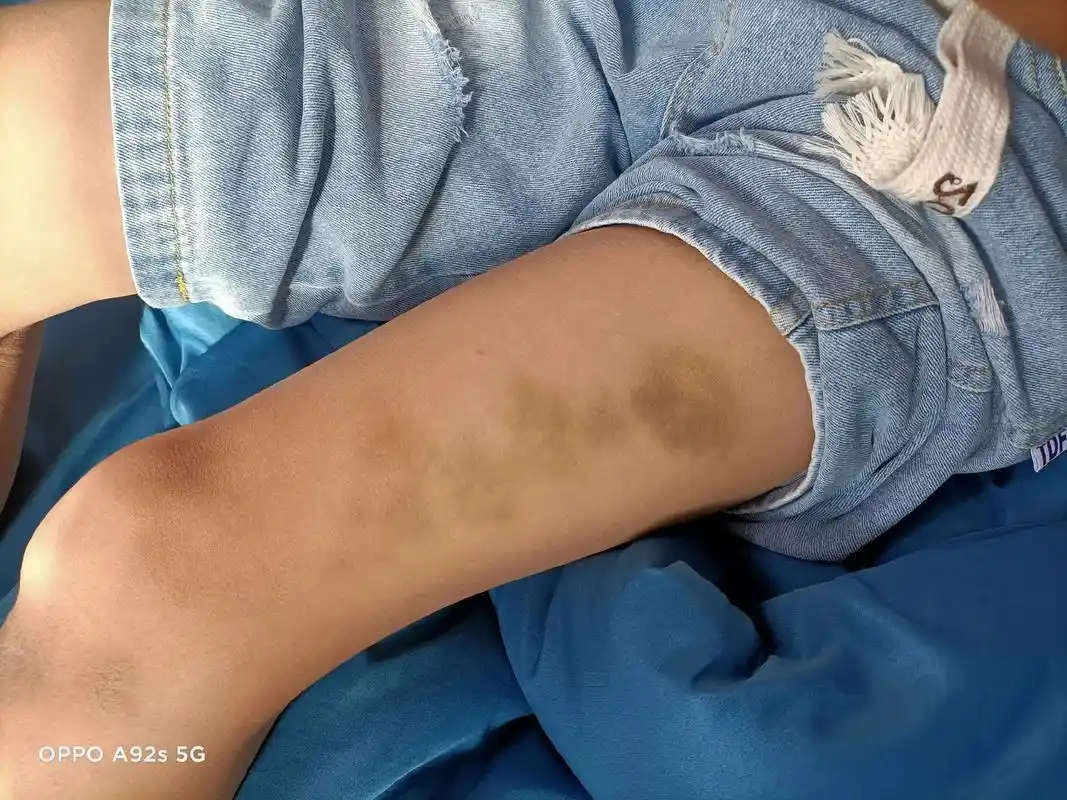 今天突然掀开家伙的裤子,看到他大腿上全是淤青,我不确定是之前 - 抖