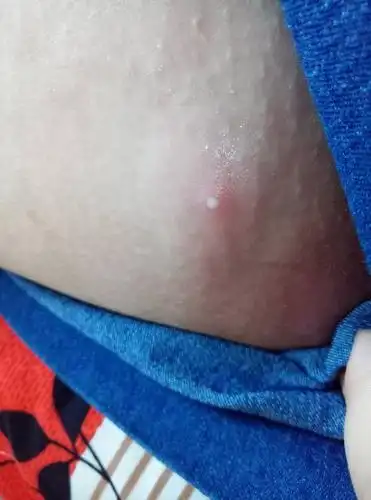 大腿内侧长出这个脓包,挤出来一次,结果很快又长出来了脓包,而且周
