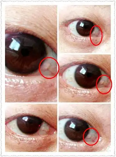 请问眼睛上的白点是什么眼病.