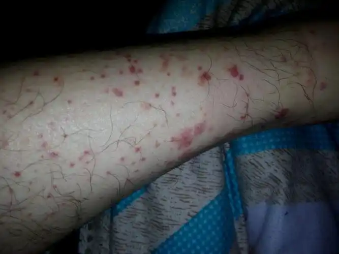 小腿红斑原先只有几个这两天变得很多不碰不痒略有突起感