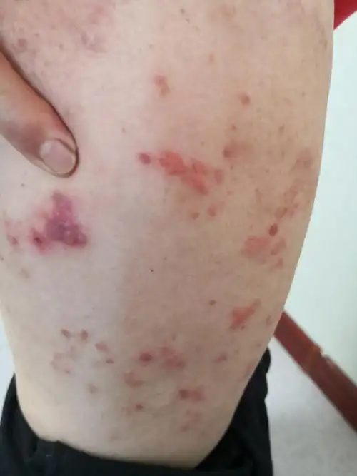 带状疱疹##解决皮肤问题专注皮肤美容