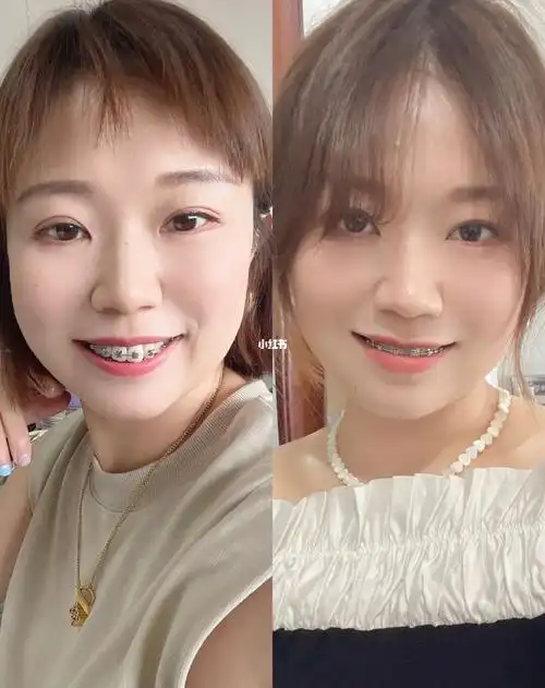 牙套16个月补上侧面对比