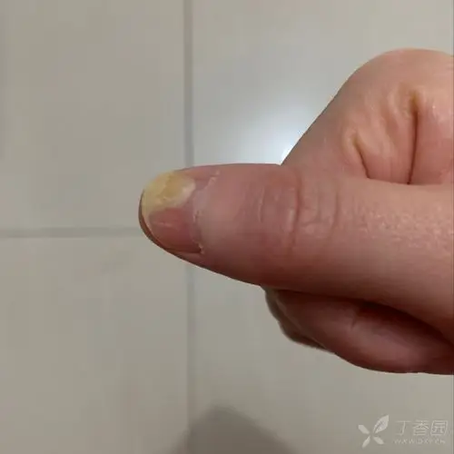 拇指指甲的白色斑块 [病例帖]