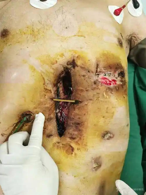 求助胃癌开腹术后切口感染修复