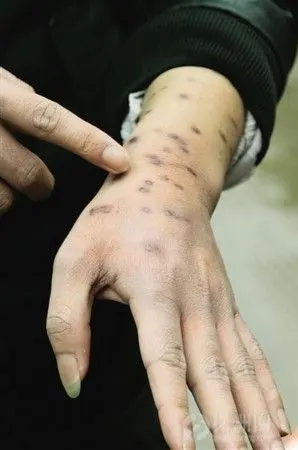 霰弹枪打出43个疤痕,至今还有3颗钢珠残留在手中见习记者熊威摄大白天