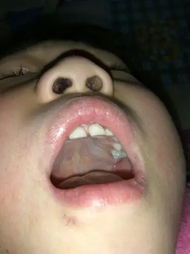 帮我看看我孩子,这是不是要出大牙呀,牙龈都肿了!