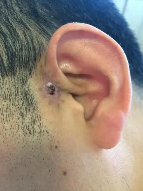 耳前瘘管第二次手术