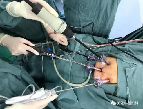 妇科微创腹腔镜手术