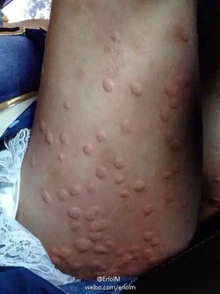 给你们科普一下什么叫蚊子咬的包!