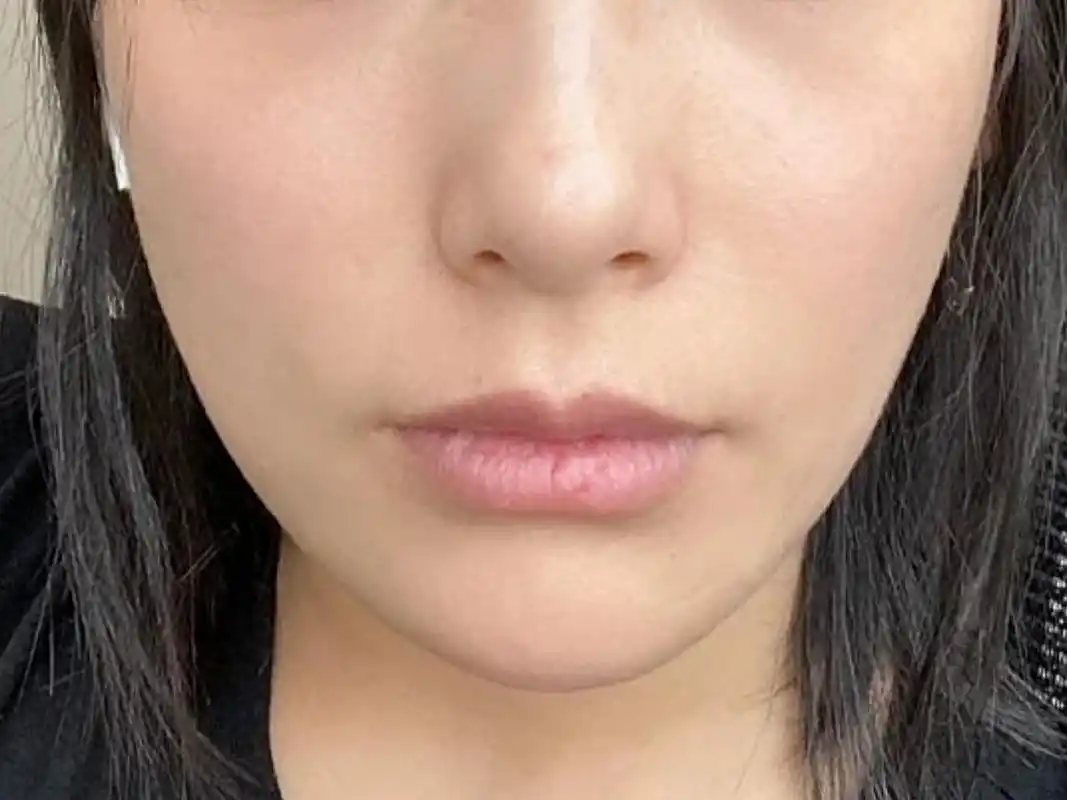 术前诊断诊断:求美者鼻基底凹陷严重,鼻部八字纹明显_圈子-新氧美容