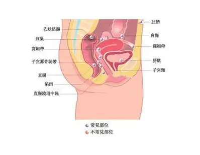 膀胱刺激征排尿障碍