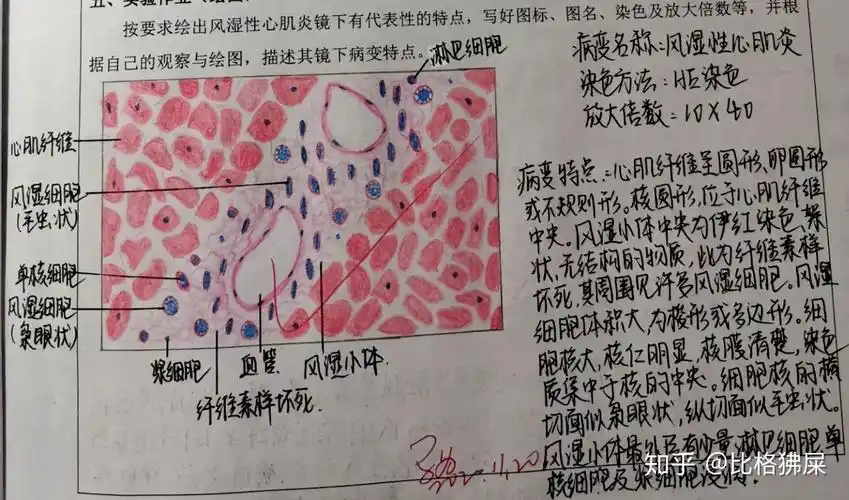 风湿性心肌炎10×40绘图要点:绘出风湿小体,风湿细胞横切面(枭眼状)和