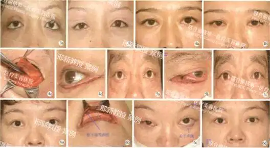 图3患者女,42岁,重睑术后双侧下睑退缩(轻度),行外眦固定术矫正3a:术