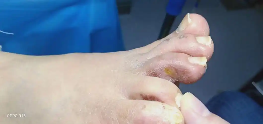 张店区中医院内分泌科糖尿病足病例 :小溃疡 大学问 咨询电话