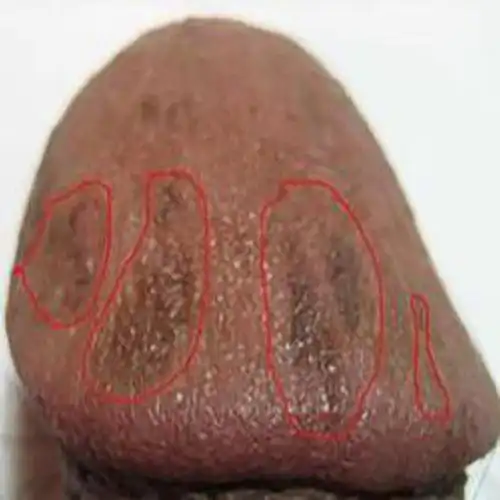 念珠菌性龟头炎图片