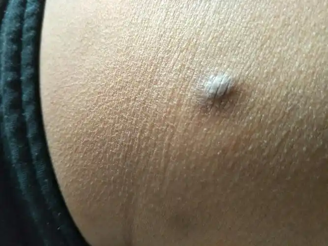 屁股长的疙瘩是什么啊.