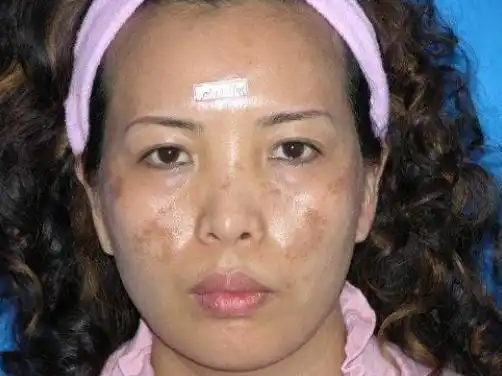 心情郁闷斑点多柿叶磨粉来敷面黄褐斑