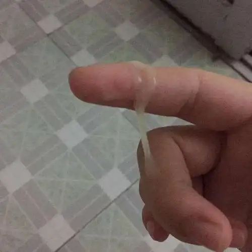 分泌物很稀且带有血,有很大的腥味,这个时候要警惕是否发展到宫颈癌