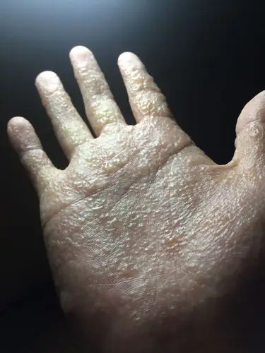 慢慢的越来越多 我还患有过敏性紫癜 不知道有没有联系 现在手上水泡