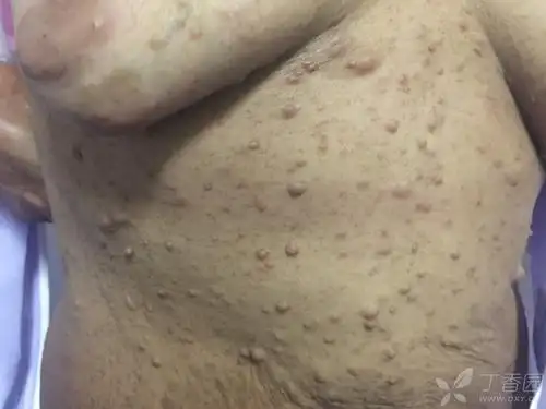 帖子详情 分享两例i型神经纤维瘤病患者皮肤照片-传说中的牛奶咖啡斑