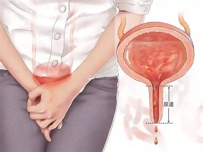 30颗珠子塞进尿道,14岁男孩差点悔恨终生_小杰_异物_膀胱