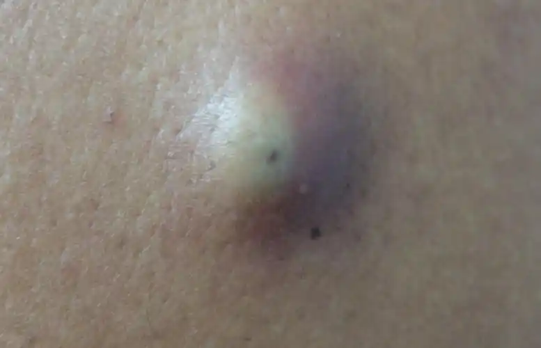 皮肤上的小肉球小肉疙瘩是什么7种可能情况有好有坏