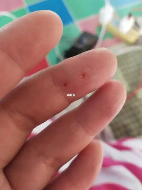 眼结石手术记录