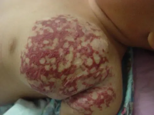 3,蔓状血管瘤:蔓状血管瘤会使患者有疼痛感,因为皮下神经可与血管瘤