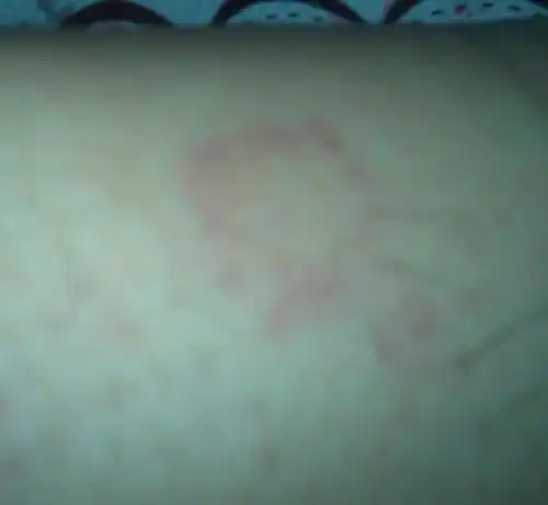 腿上长了红圈圈,不疼不痒,帮忙看看怎么回事?